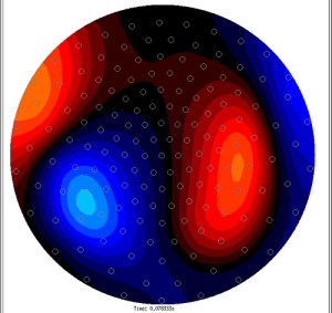 The brain is the most mysterious and little understood of all human organs. This is largely due to the fact that it has been virtually impossible to study the living brain in a non-invasive manner. Dramatic advances in technology, however, are changing all this. Sophisticated new brain scan instruments are making it possible to collect remarkably accurate spatial and temporal information about neural activity in the brain in a non-invasive fashion, literally making it possible to image thinking and seeing. This image is a snapshot of Professor Babul's brain. It was created using the MEG facility at the Down Syndrome Research Foundation in Vancouver, BC. This MEG is the first of its kind in Western Canada. 