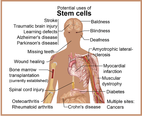 Diseases and conditions where stem cell treatment is promising or emerging. Please click for article "A  Shia Muslim Perspective on Stem Cell Research." Image: Wikipedia.